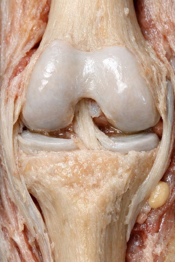 🦴 آسٹیوپروسس (Osteoporosis) کیا ہے؟